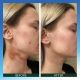 Sorted Skin Intensive Rescue Spray- Prebiotic Microbiome based